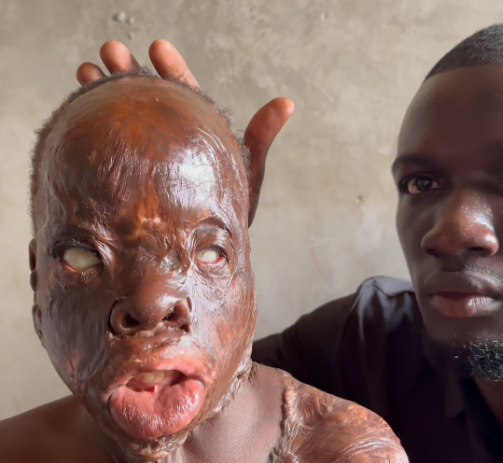A Fire Changed Samuel's Life Forever